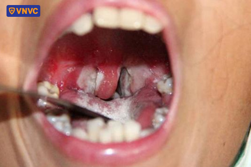 giả mạc bạch hầu ở họng