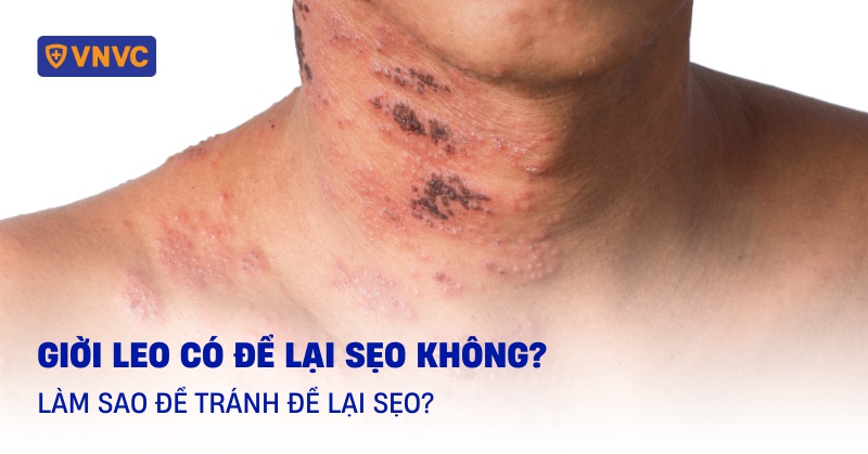 giời leo có để lại sẹo không