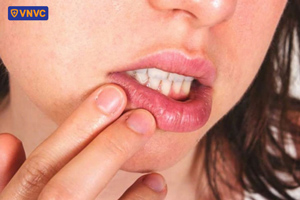 giời leo ở miệng gây đau nhức