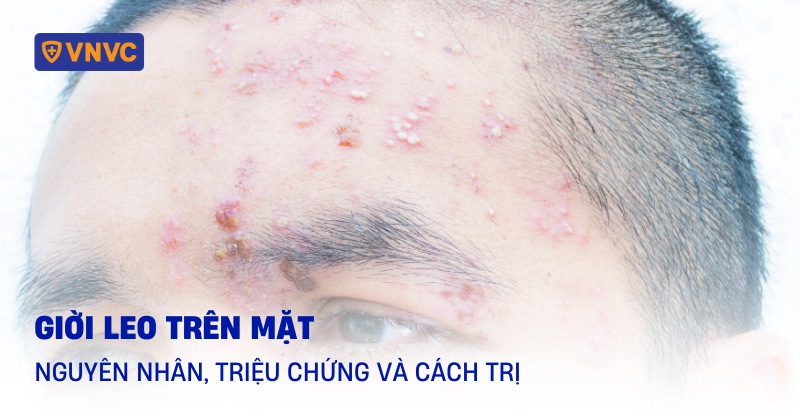 giời leo trên mặt