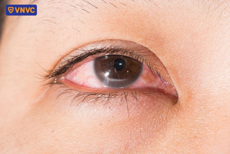 herpes ở mắt