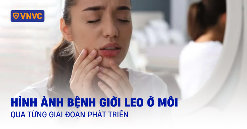 hình ảnh bệnh giời leo ở môi