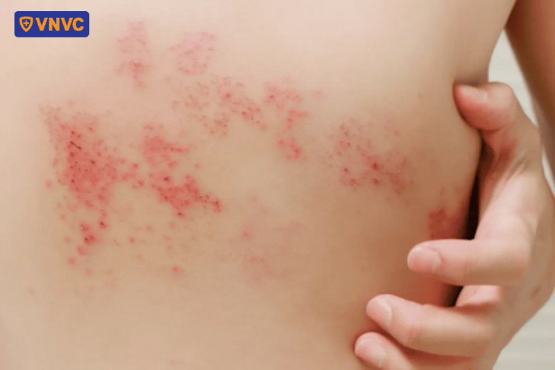 hình ảnh bệnh giời leo