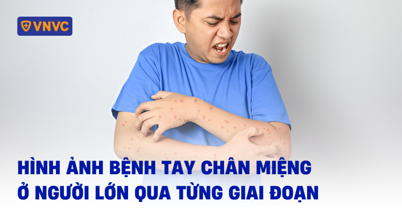 hình ảnh bệnh tay chân miệng ở người lớn