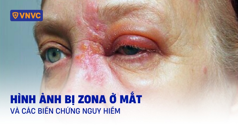 hình ảnh bị zona ở mắt