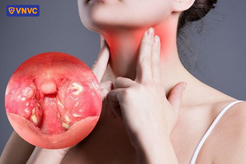 hình ảnh giả mạc bạch hầu