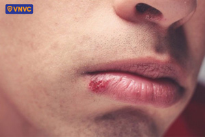 hình ảnh mụn nước herpes