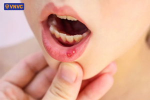 hình ảnh nhiệt miệng