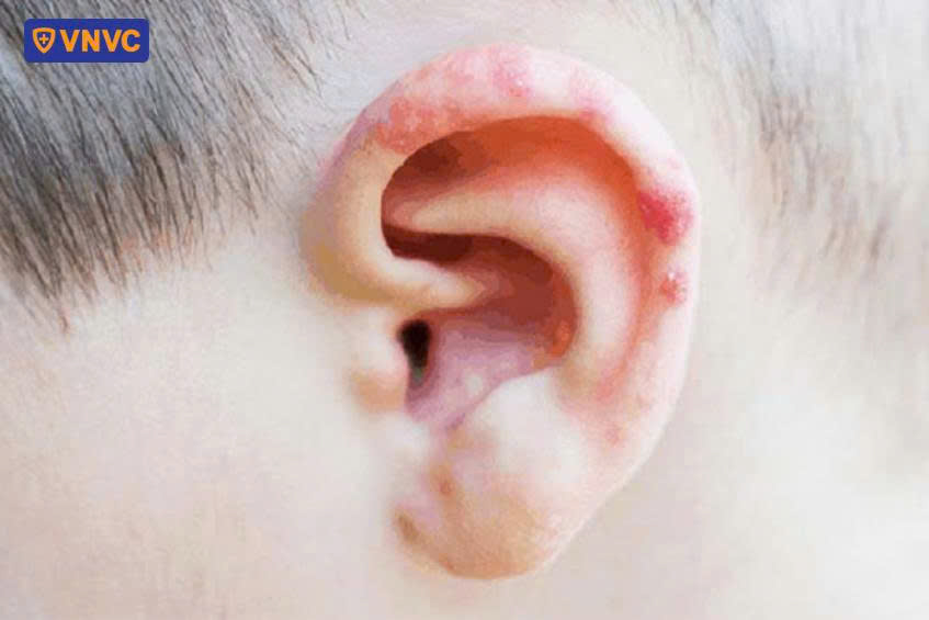 hình ảnh zona thần kinh ở tai