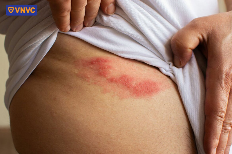 mắc giời leo bao lâu khỏi