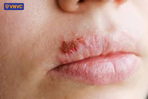 mụn nước giời leo đóng vảy và lành da