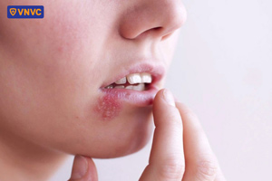 mụn nước giời leo ở môi vỡ ra