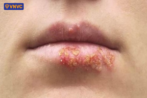 mụn nước zona chứa chất dịch lỏng