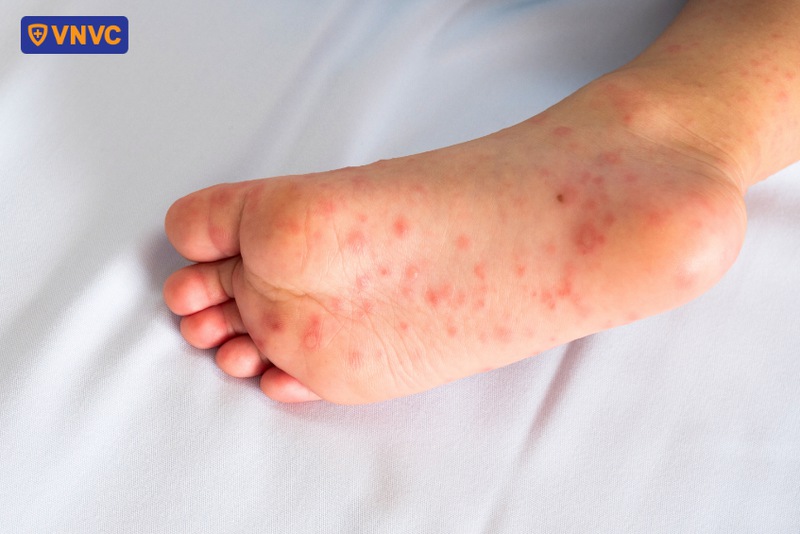 mụn tay chân miệng nổi ở chân