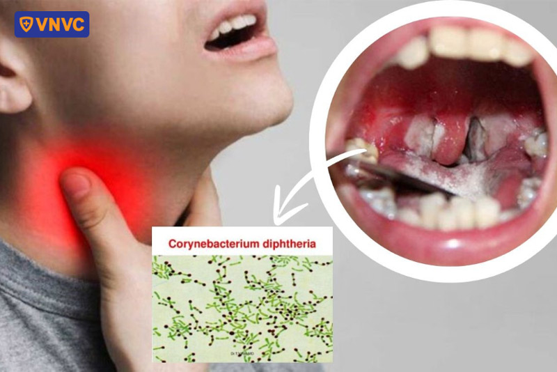 người bị bệnh bạch hầu