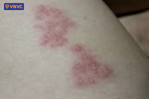 nốt ban đỏ giời leo