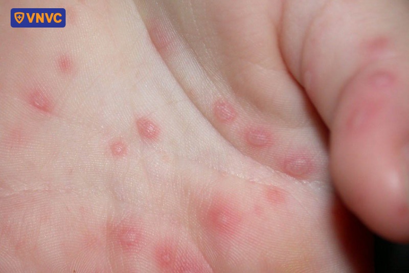nốt ban trên da do bệnh tay chân miệng