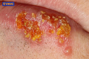 nốt mụn herpes giai đoạn hồi phục