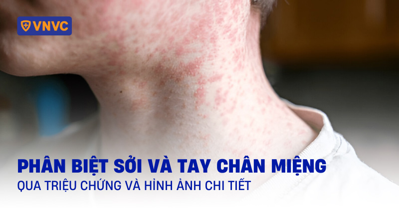 phân biệt sởi và tay chân miệng