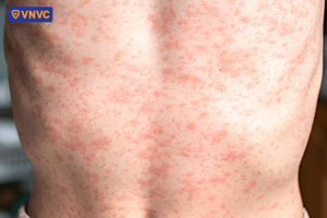 phát ban ở bệnh sởi