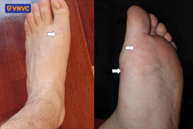 tay chân miệng người lớn giai đoạn hồi phục