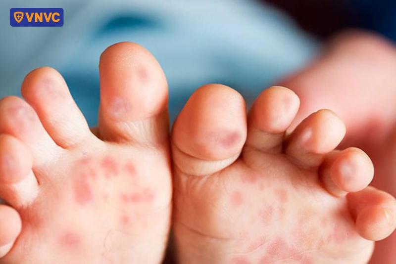tay chân miệng phát ban đỏ