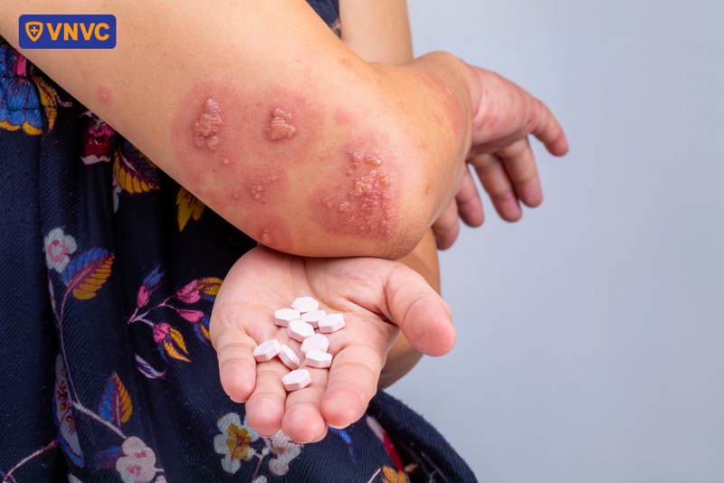 thuốc điều trị giời leo
