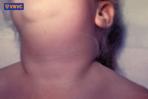 trẻ bị sưng dưới hàm và má