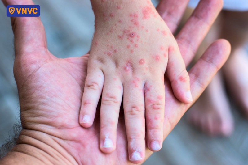 trẻ bị tay chân miệng cách ly bao lâu