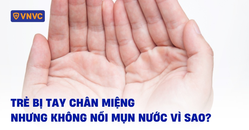 Trẻ bị tay chân miệng nhưng không nổi mụn nước vì sao? [Giải đáp]