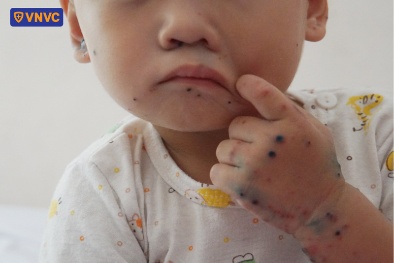 Nhấn vào ảnh để phóng to trẻ mắc tay chân miệng