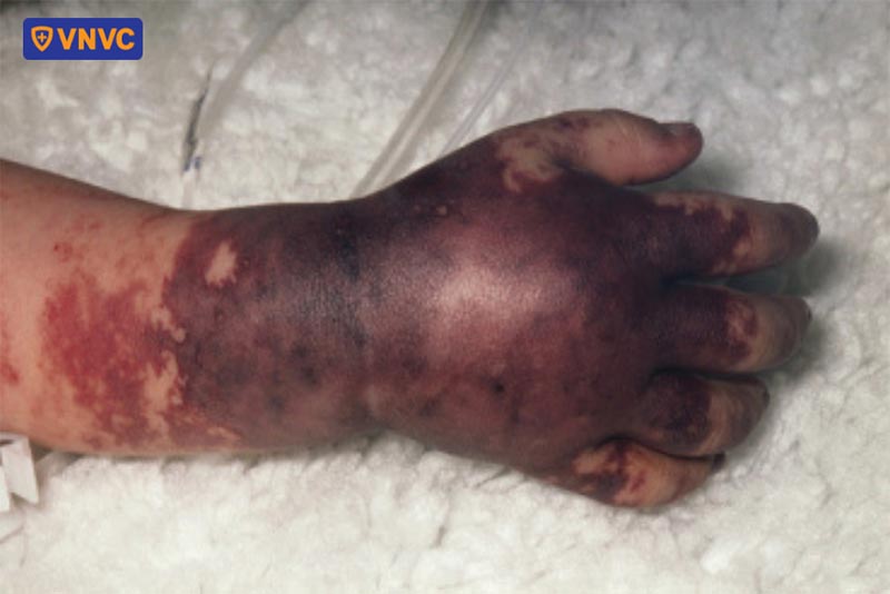 tử ban não mô cầu màu tím