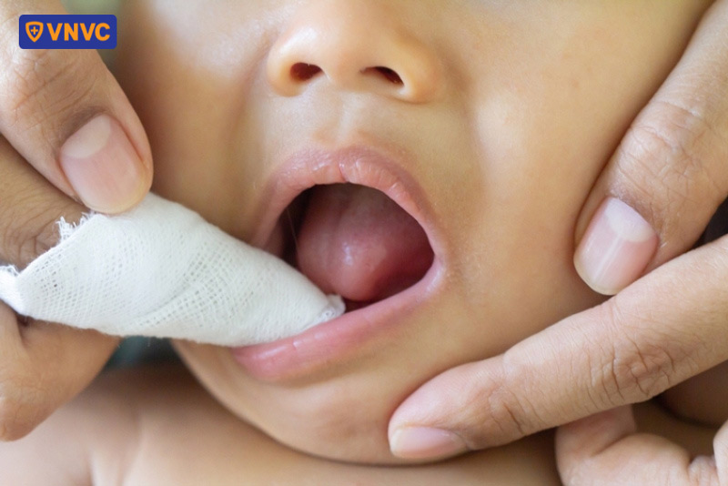 vệ sinh vết loét miệng tay chân miệng