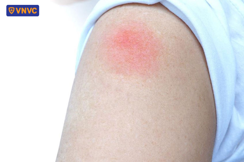 vết đỏ do tiêm hpv