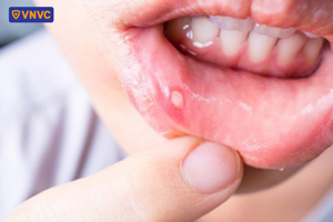 vết loét do nhiệt miệng
