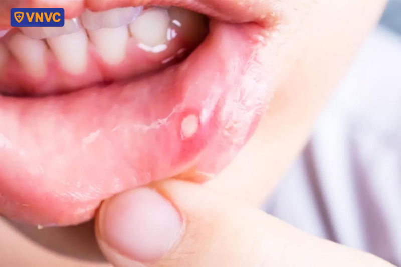Nhấn vào ảnh để phóng to vết loét miệng