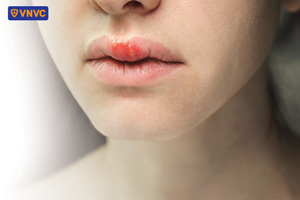 vết loét ở môi do herpes