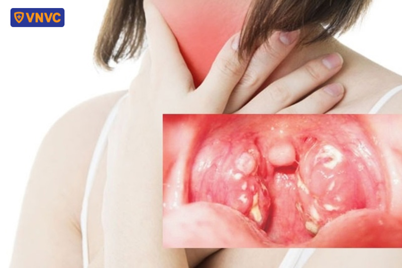 vi khuẩn bạch hầu lây nhiễm qua đường hô hấp