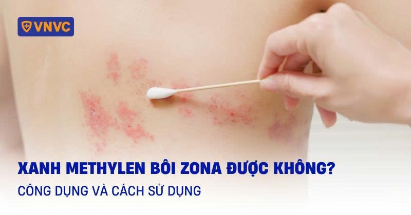 xanh methylen bôi zona được không