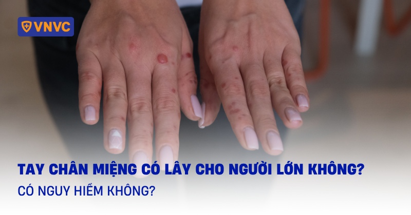 bệnh tay chân miệng có lây cho người lớn không