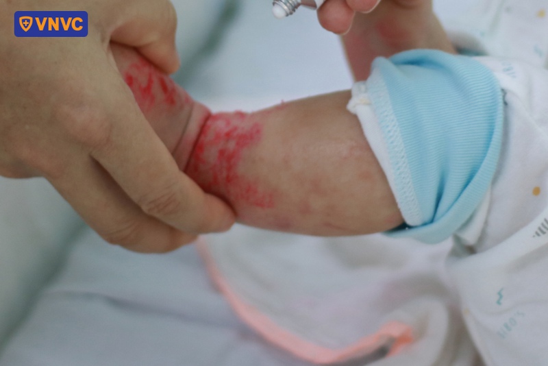 bệnh tay chân miệng ở trẻ em