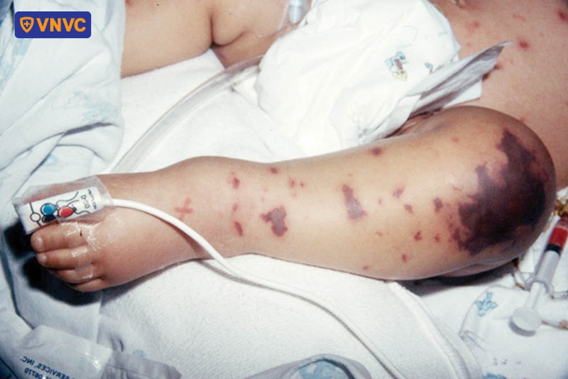 biểu hiện tử ban của não mô cầu