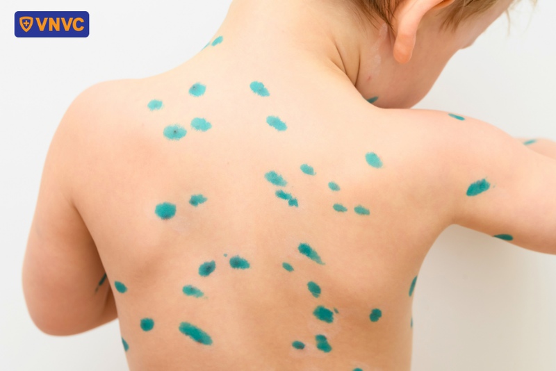 bôi thuốc xanh methylen theo chỉ định bác sĩ