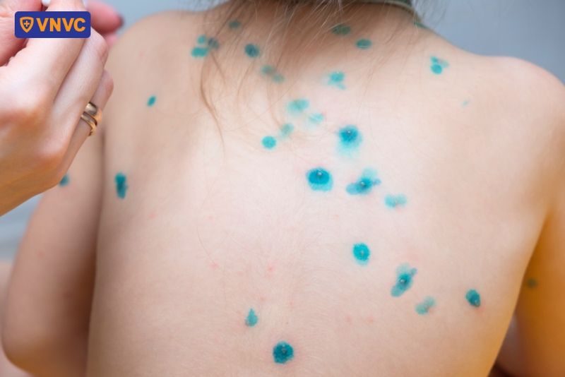 chân tay miệng bôi xanh methylen