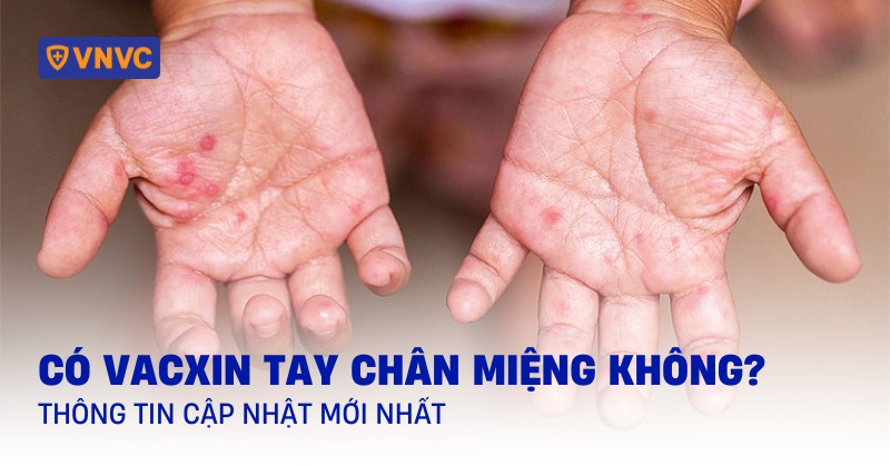có vacxin tay chân miệng không
