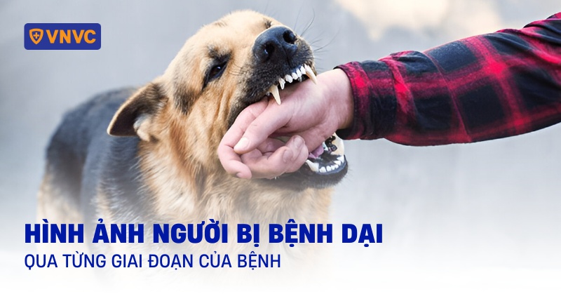 hình ảnh người bị bệnh dại