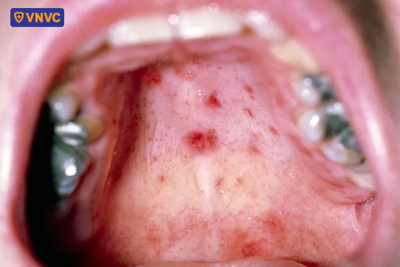 mụn nước tay chân miệng nổi nhiều có sao không