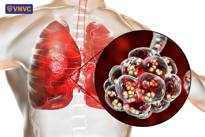 phế cầu khuẩn gây bệnh về đường hô hấp