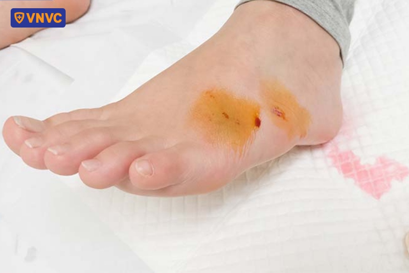 sơ cứu vết thương khi bị chó cào