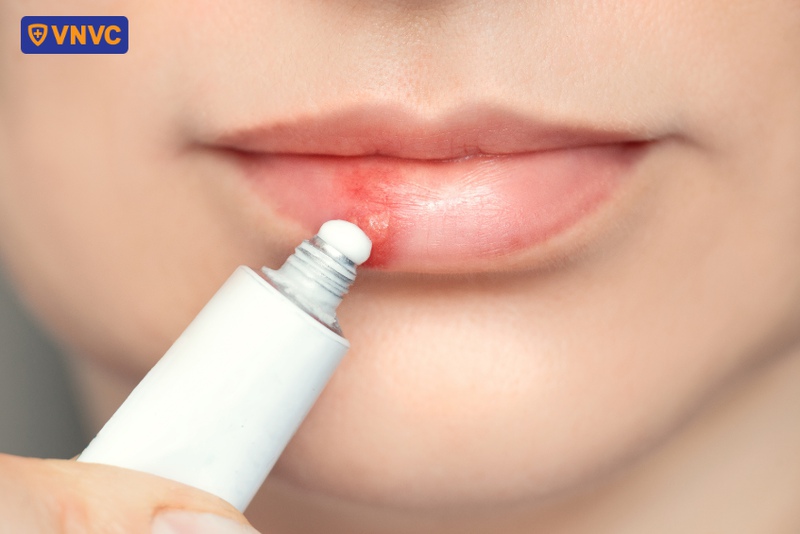 sử dụng acyclovir để bôi ngoài da
